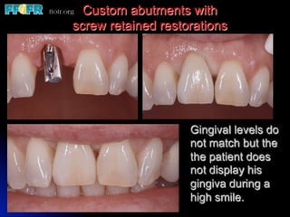 Custom abutments with
screw retained restorations




                    Gingival levels do
                    not match but the
                    the patient does
                    not display his
                    gingiva during a
                    high smile.
 