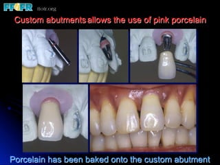 Custom abutments allows the use of pink porcelain




Porcelain has been baked onto the custom abutment
 