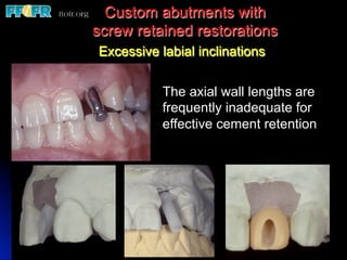 Custom abutments with
screw retained restorations
Excessive labial inclinations


           The axial wall lengths are
           frequently inadequate for
           effective cement retention
 