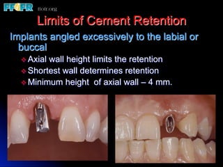 Limits of Cement Retention
Implants angled excessively to the labial or
  buccal
  v  Axialwall height limits the retention
  v  Shortest wall determines retention
  v  Minimum height of axial wall – 4 mm.
 