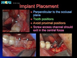 Implant Placement
    v  Perpendicular   to the occlusal
        plane
    v  Tooth positions
    v  Avoid proximal positions
    v  Screw access channel should
        exit in the central fossa
 