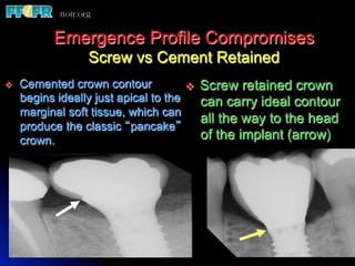 Emergence Profile Compromises
                   Screw vs Cement Retained
v    Cemented crown contour            v  Screw retained crown
      begins ideally just apical to the     can carry ideal contour
      marginal soft tissue, which can
                                            all the way to the head
      produce the classic “pancake”
      crown.                                of the implant (arrow)
 