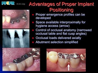 Advantages of Proper Implant
        Positioning
 l    Proper emergence profiles can be
       developed
 l    Space available interproximally for
       hygiene access (arrow)
 l    Control of occlusal anatomy (narrowed
       occlusal table and flat cusp angles)
 l    Occlusal loads delivered axially
 l    Abutment selection simplified
 