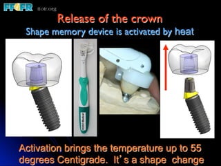 Release of the crown	

 Shape memory device is activated by heat	





Activation brings the temperature up to 55
degrees Centigrade. It’s a shape change
 