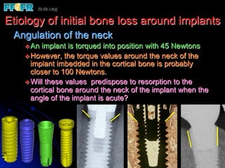 Etiology of initial bone loss around implants
 Angulation of the neck
    v An  implant is torqued into position with 45 Newtons
    v However, the torque values around the neck of the
       implant imbedded in the cortical bone is probably
       closer to 100 Newtons.
    v Will these values predispose to resorption to the
       cortical bone around the neck of the implant when the
       angle of the implant is acute?
 