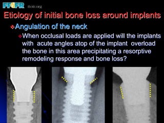 Etiology of initial bone loss around implants
 v Angulation   of the neck
    v Whenocclusal loads are applied will the implants
     with acute angles atop of the implant overload
     the bone in this area precipitating a resorptive
     remodeling response and bone loss?
 