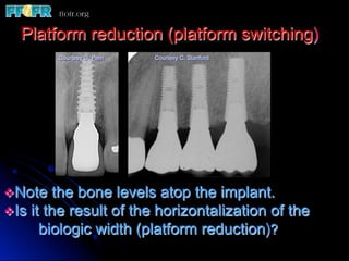 Platform reduction (platform switching)
         Courtesy G. Perri   Courtesy C. Stanford




v Note the bone levels atop the implant.
v Is it the result of the horizontalization of     the
     biologic width (platform reduction)?
 