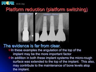 Platform reduction (platform switching)
          Courtesy G. Perri   Courtesy C. Stanford




The evidence is far from clear.
  v In these examples the angulation of the top of the
       implant may be the more important factor
  v In addition in both these implant systems the micro-rough
       surface was extended to the top of the implant. This also,
       may contribute to the maintenance of bone levels atop
       the implant.
 
