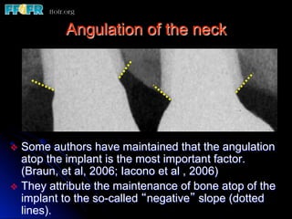 Angulation of the neck




v  Some    authors have maintained that the angulation
    atop the implant is the most important factor.
    (Braun, et al, 2006; Iacono et al , 2006)
v  They attribute the maintenance of bone atop of the
    implant to the so-called “negative” slope (dotted
    lines).
 
