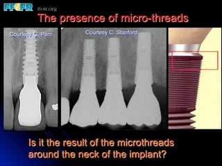 The presence of micro-threads
Courtesy G. Perri    Courtesy C. Stanford




       Is it the result of the microthreads
       around the neck of the implant?
 
