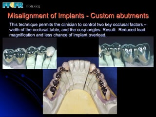 Misalignment of Implants - Custom abutments
This technique permits the clinician to control two key occlusal factors –
width of the occlusal table, and the cusp angles. Result: Reduced load
magnification and less chance of implant overload.
 