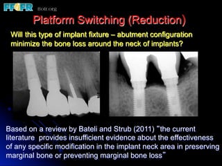 Platform Switching (Reduction)
 Will this type of implant fixture – abutment configuration
 minimize the bone loss around the neck of implants?




Based on a review by Bateli and Strub (2011) “the current
literature provides insufficient evidence about the effectiveness
of any specific modification in the implant neck area in preserving
marginal bone or preventing marginal bone loss”
 