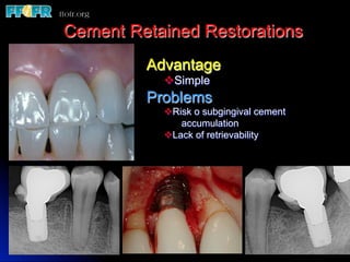 Cement Retained Restorations
         Advantage
           v Simple
         Problems
           v Risk o subgingival cement
                accumulation
           v Lack of retrievability
 