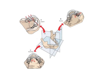Frs Rpd 6-BIOMECHANICS OF RPD.pptx removable prosthodontics | PPTX
