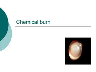 Chemical burn
 