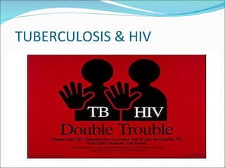 TUBERCULOSIS & HIV 