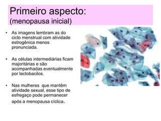 Primeiro aspecto:
(menopausa inicial)
• As imagens lembram as do
ciclo menstrual com atividade
estrogênica menos
pronunciada.
• As células intermediárias ficam
majoritárias e são
acompanhadas eventualmente
por lactobacilos.
• Nas mulheres que mantêm
atividade sexual, esse tipo de
esfregaço pode permanecer
após a menopausa cíclica.
 