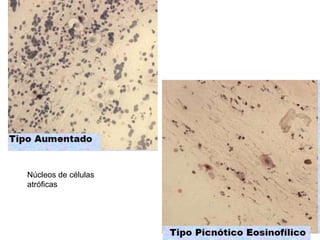 Núcleos de células
atróficas
 