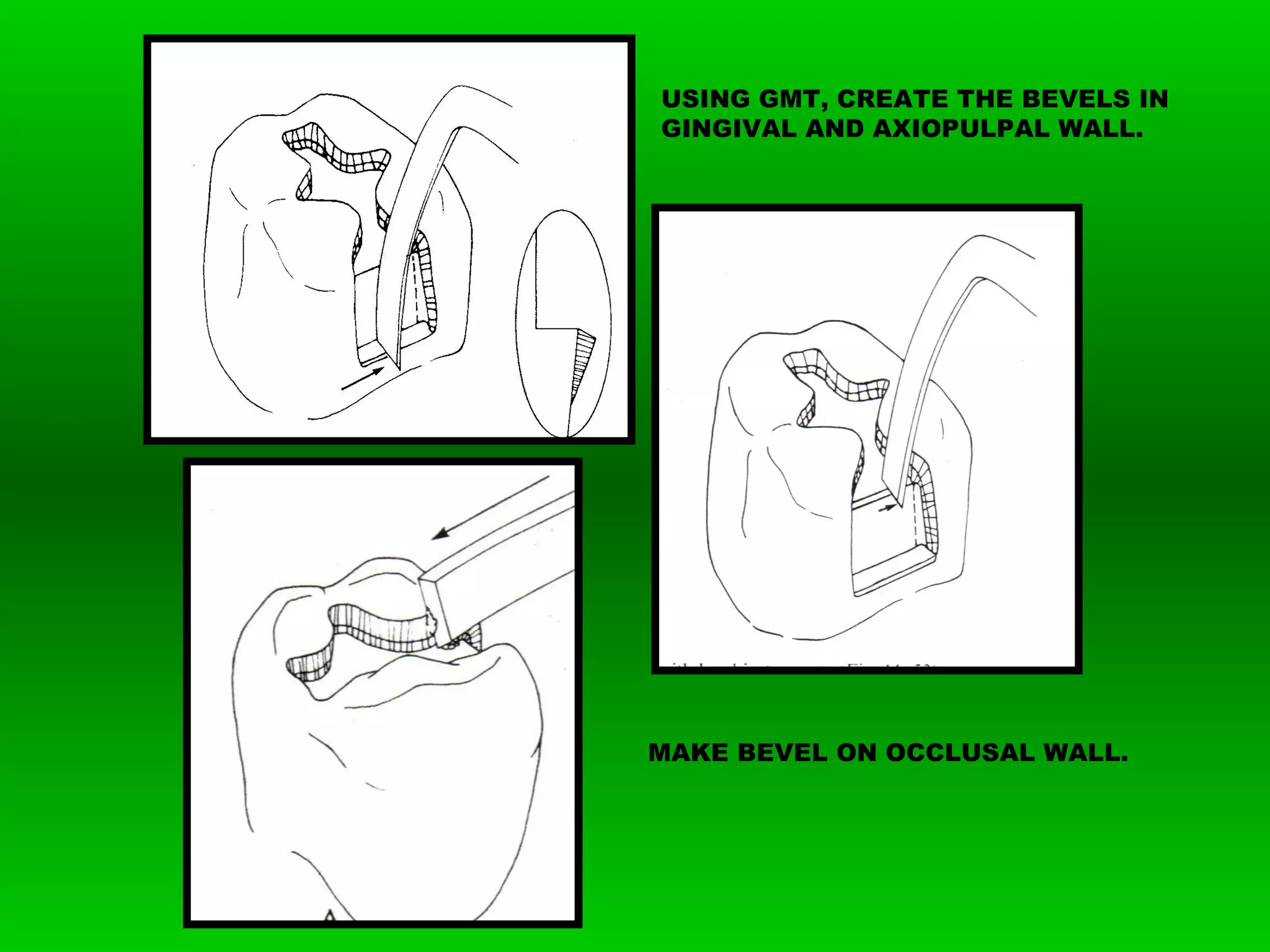 Class II Amalgam Preparation