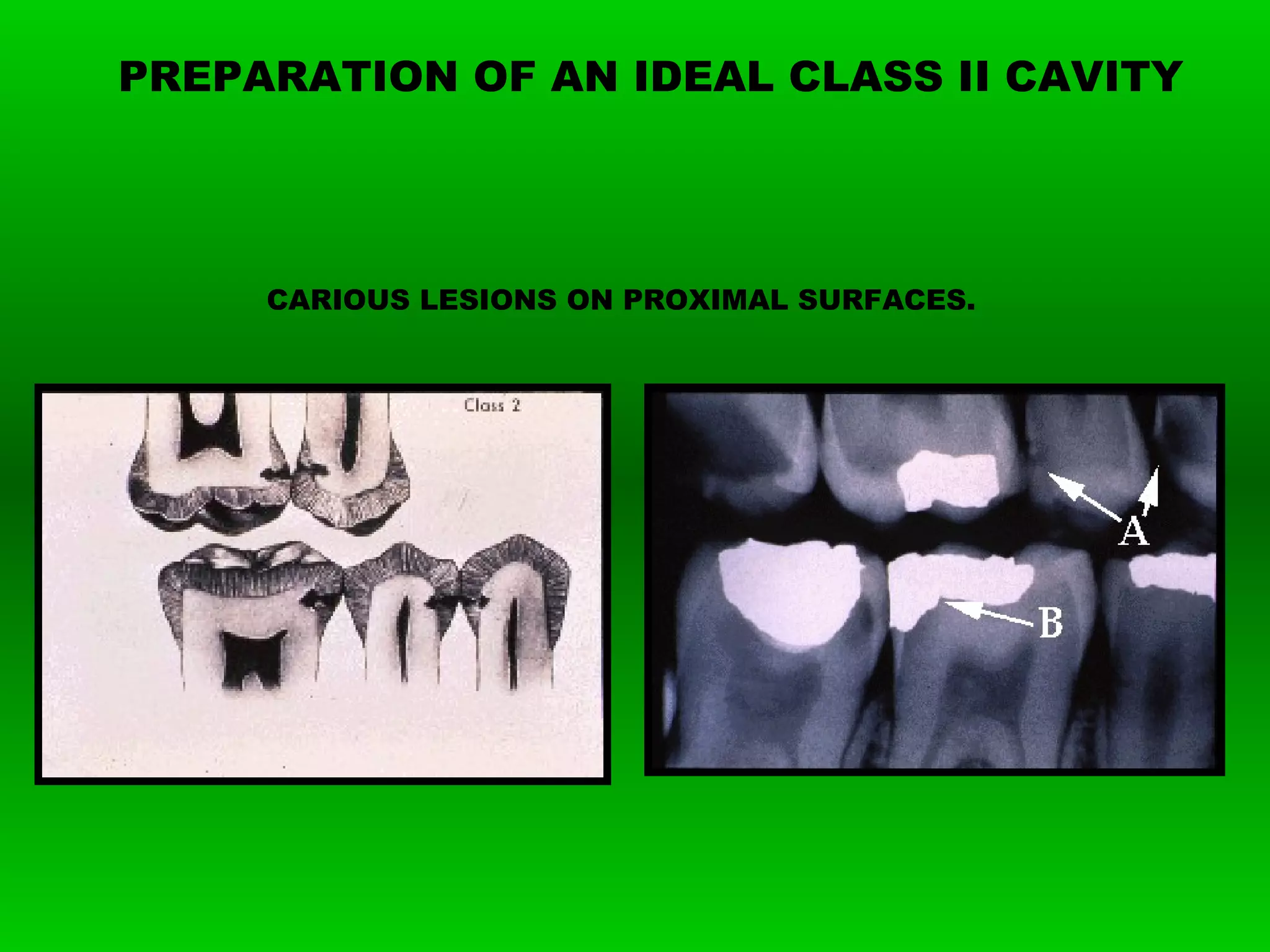 Class II Amalgam Preparation