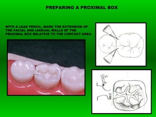 WITH A LEAD PENCIL, MARK THE EXTENSION OF
THE FACIAL AND LINGUAL WALLS OF THE
PROXIMAL BOX RELATIVE TO THE CONTACT AREA.
PREPARING A PROXIMAL BOX
 