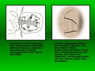 CREATE A REVERSE CURVE IN
AN OCCLUSAL OUTLINE. THIS
WILL RESULT WHEN
DEVELOPING THE MESIO FACIAL
WALL PERPENDICULAR TO THE
ENAMEL ROD DIRECTION.
HOWEVER, THE REVERSE CURVE
ON THE LINGUAL ASPECT WILL
BE MINIMAL.
ESTABLISH 0.5 MM CLEARANCE
WITH THE ADJACENT PROXIMAL
SURFACE FACIALLY, LINGUALLY
AND GINGIVALLY.CHECK
CLEARANCE WITH THE TINE OF
EXPLORER.
 