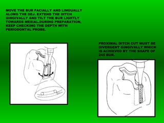 MOVE THE BUR FACIALLY AND LINGUALLY
ALONG THE DEJ. EXTEND THE DITCH
GINGIVALLY AND TILT THE BUR LIGHTLY
TOWARDS MESIAL.DURING PREPARATION,
KEEP CHECKING THE DEPTH WITH
PERIODONTAL PROBE.
PROXIMAL DITCH CUT MUST BE
DIVERGENT GINGIVALLY WHICH
IS ACHIEVED BY THE SHAPE OF
245 BUR.
 