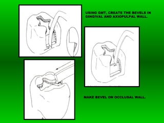USING GMT, CREATE THE BEVELS IN
GINGIVAL AND AXIOPULPAL WALL.
MAKE BEVEL ON OCCLUSAL WALL.
 
