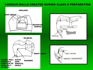 VARIOUS WALLS CREATED DURING CLASS II PREPARATION
RIGHT ANGLE
NO BEVEL
ROUNDED
ENAMEL WALL
PARALLELS
DIRECTION OF
RODS ONLY –
NO BEVEL
ACUTE
AXIO-
GINGIVAL
ANGLE
RETENTIVE
GROOVE
AMALGAM
RIGHT ANGLE
 