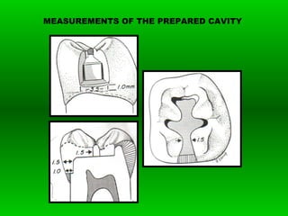 MEASUREMENTS OF THE PREPARED CAVITY
 