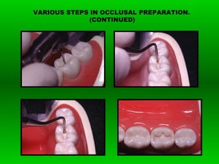 VARIOUS STEPS IN OCCLUSAL PREPARATION.
(CONTINUED)
 