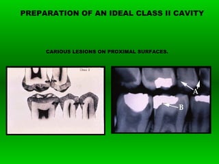 PREPARATION OF AN IDEAL CLASS II CAVITY
CARIOUS LESIONS ON PROXIMAL SURFACES.
 