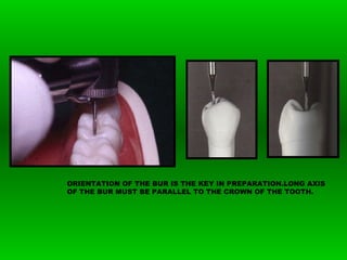 ORIENTATION OF THE BUR IS THE KEY IN PREPARATION.LONG AXIS
OF THE BUR MUST BE PARALLEL TO THE CROWN OF THE TOOTH.
 