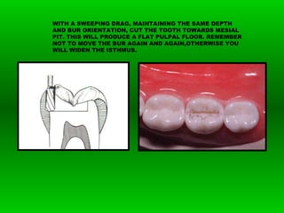 WITH A SWEEPING DRAG, MAINTAINING THE SAME DEPTH
AND BUR ORIENTATION, CUT THE TOOTH TOWARDS MESIAL
PIT. THIS WILL PRODUCE A FLAT PULPAL FLOOR. REMEMBER
NOT TO MOVE THE BUR AGAIN AND AGAIN,OTHERWISE YOU
WILL WIDEN THE ISTHMUS.
 