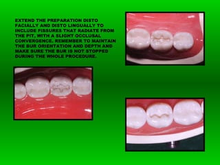 EXTEND THE PREPARATION DISTO
FACIALLY AND DISTO LINGUALLY TO
INCLUDE FISSURES THAT RADIATE FROM
THE PIT, WITH A SLIGHT OCCLUSAL
CONVERGENCE. REMEMBER TO MAINTAIN
THE BUR ORIENTATION AND DEPTH AND
MAKE SURE THE BUR IS NOT STOPPED
DURING THE WHOLE PROCEDURE.
 