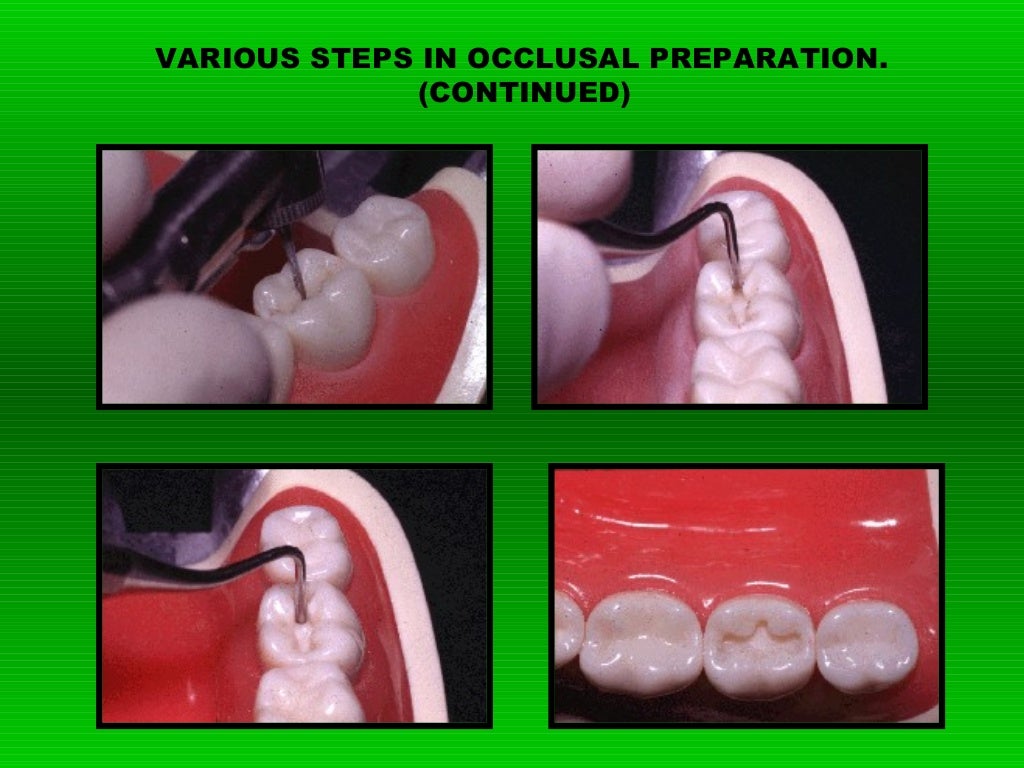 Class II Amalgam Preparation