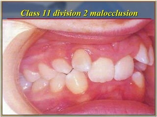 Class 11 division 2 malocclusion 