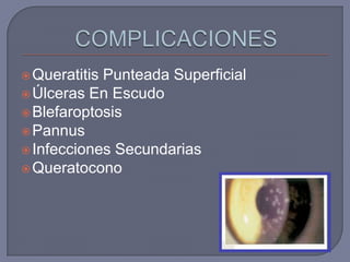  QueratitisPunteada Superficial
 Úlceras En Escudo
 Blefaroptosis
 Pannus
 Infecciones Secundarias
 Queratocono
 
