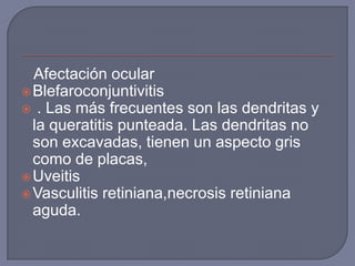 Afectación ocular
 Blefaroconjuntivitis
 . Las más frecuentes son las dendritas y
  la queratitis punteada. Las dendritas no
  son excavadas, tienen un aspecto gris
  como de placas,
 Uveitis
 Vasculitis retiniana,necrosis retiniana
  aguda.
 