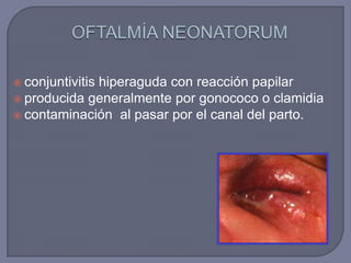  conjuntivitis
             hiperaguda con reacción papilar
 producida generalmente por gonococo o clamidia
 contaminación al pasar por el canal del parto.
 