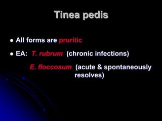 Tinea pedis