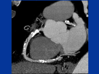 Chapter 6- Chest & Cardiovascular radiology.pdf
