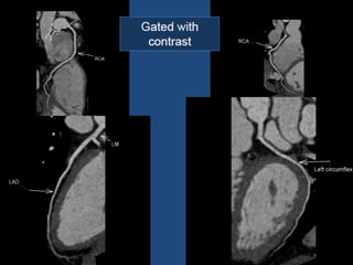 Chapter 6- Chest & Cardiovascular radiology.pdf