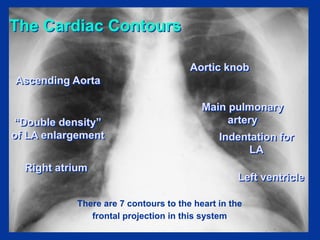 Chapter 6- Chest & Cardiovascular radiology.pdf