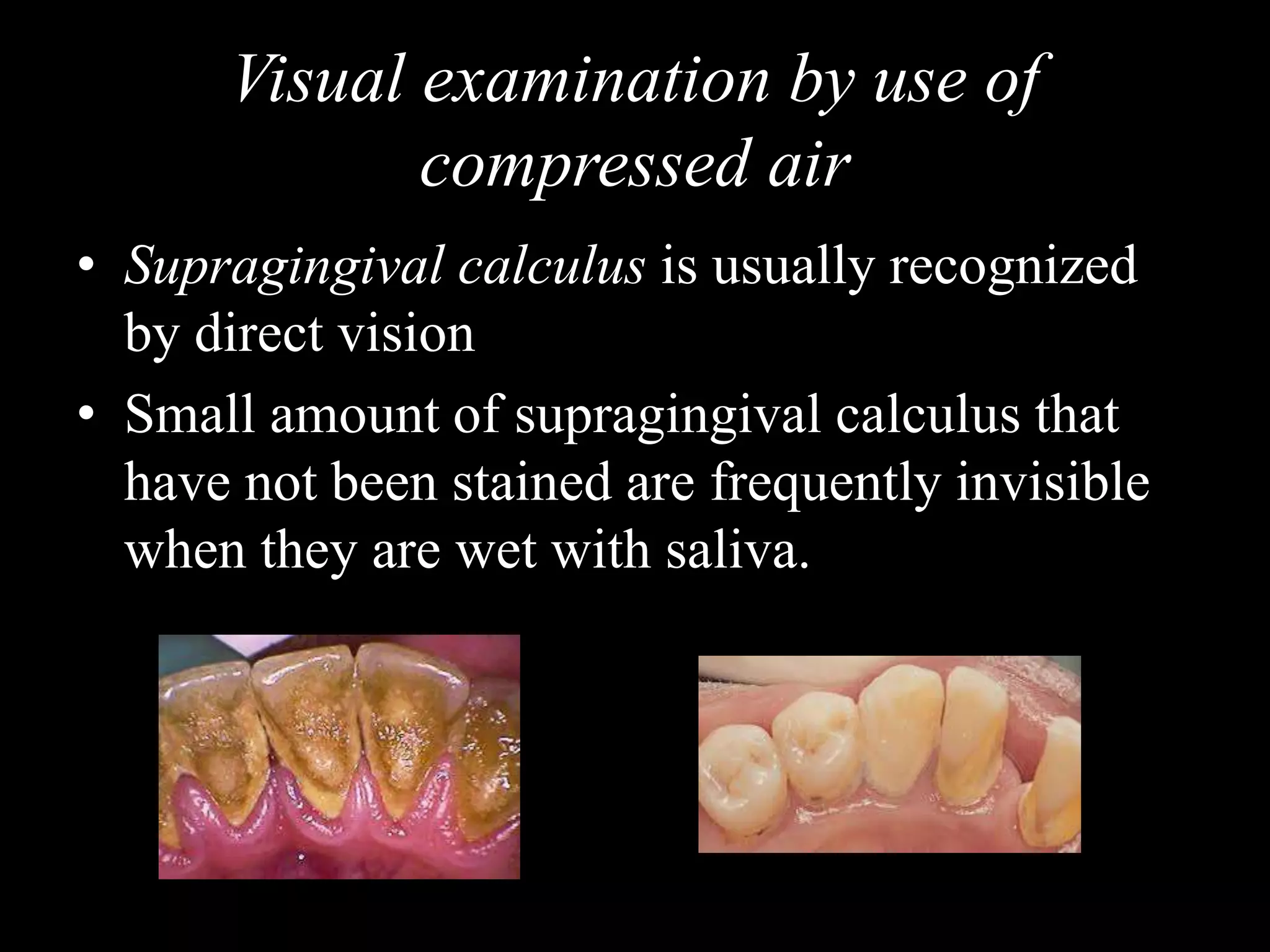 Visual examination by use of
compressed air
• Supragingival calculus is usually recognized
by direct vision
• Small amount of supragingival calculus that
have not been stained are frequently invisible
when they are wet with saliva.
 