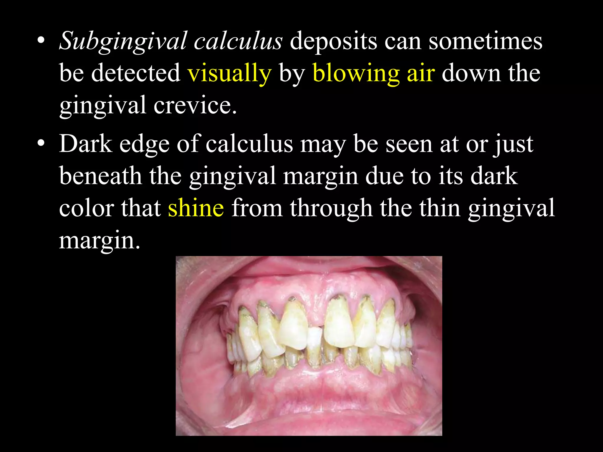• Subgingival calculus deposits can sometimes
be detected visually by blowing air down the
gingival crevice.
• Dark edge of calculus may be seen at or just
beneath the gingival margin due to its dark
color that shine from through the thin gingival
margin.
 