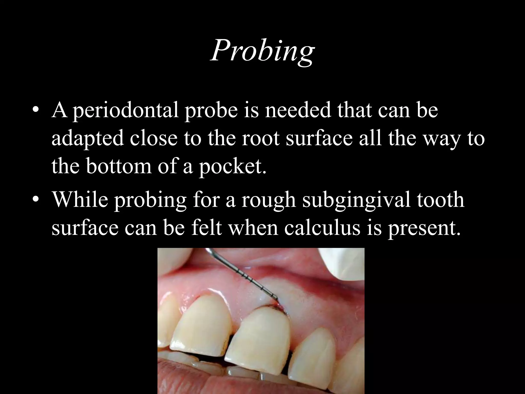 Probing
• A periodontal probe is needed that can be
adapted close to the root surface all the way to
the bottom of a pocket.
• While probing for a rough subgingival tooth
surface can be felt when calculus is present.
 