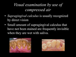 Visual examination by use of
compressed air
• Supragingival calculus is usually recognized
by direct vision
• Small amount of supragingival calculus that
have not been stained are frequently invisible
when they are wet with saliva.
 