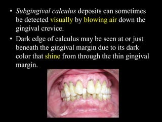 • Subgingival calculus deposits can sometimes
be detected visually by blowing air down the
gingival crevice.
• Dark edge of calculus may be seen at or just
beneath the gingival margin due to its dark
color that shine from through the thin gingival
margin.
 