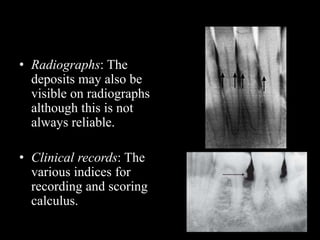 • Radiographs: The
deposits may also be
visible on radiographs
although this is not
always reliable.
• Clinical records: The
various indices for
recording and scoring
calculus.
 